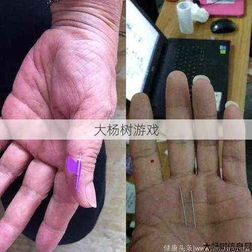 医学界的神奇：一根针就搞定！ 第2张